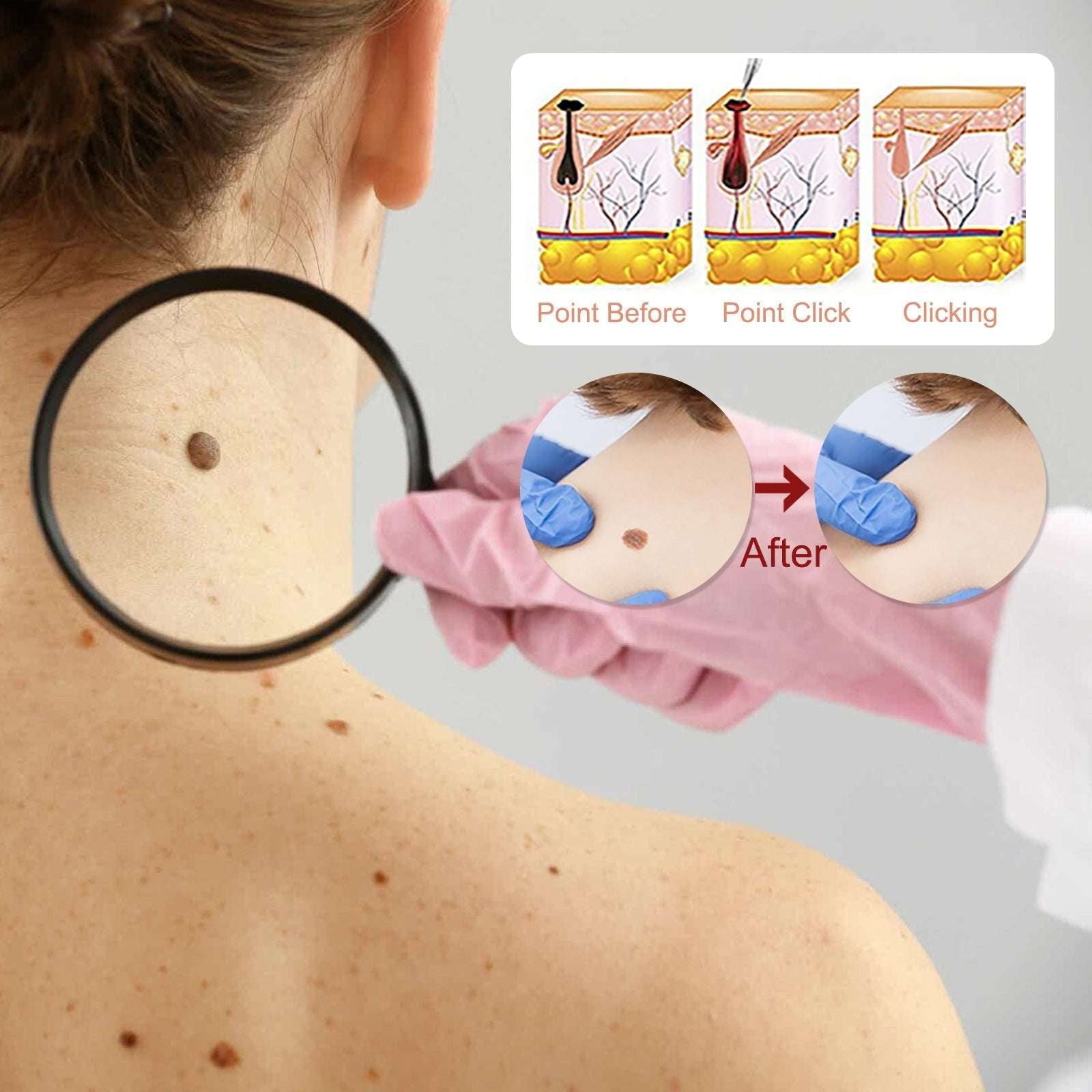 Armpit Removal, Neck Removal, Skin Removal - available at Sparq Mart